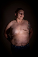 Jodi M - Breast reconstruction before